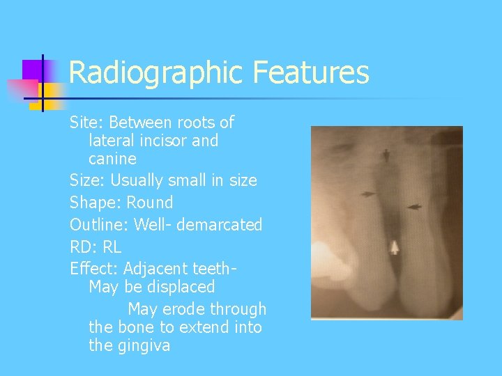 Radiographic Features Site: Between roots of lateral incisor and canine Size: Usually small in Radiographic Features Site: Between roots of lateral incisor and canine Size: Usually small in
