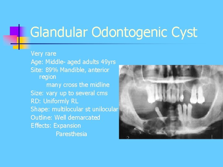 Glandular Odontogenic Cyst Very rare Age: Middle- aged adults 49 yrs Site: 89% Mandible, Glandular Odontogenic Cyst Very rare Age: Middle- aged adults 49 yrs Site: 89% Mandible,