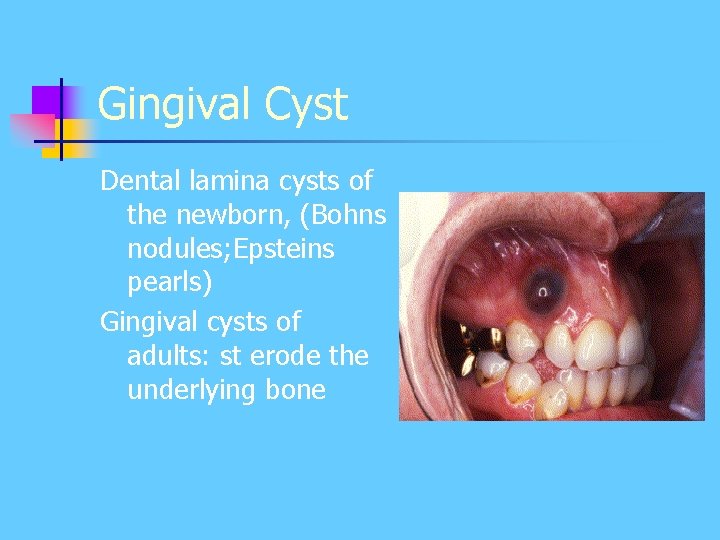 Gingival Cyst Dental lamina cysts of the newborn, (Bohns nodules; Epsteins pearls) Gingival cysts Gingival Cyst Dental lamina cysts of the newborn, (Bohns nodules; Epsteins pearls) Gingival cysts