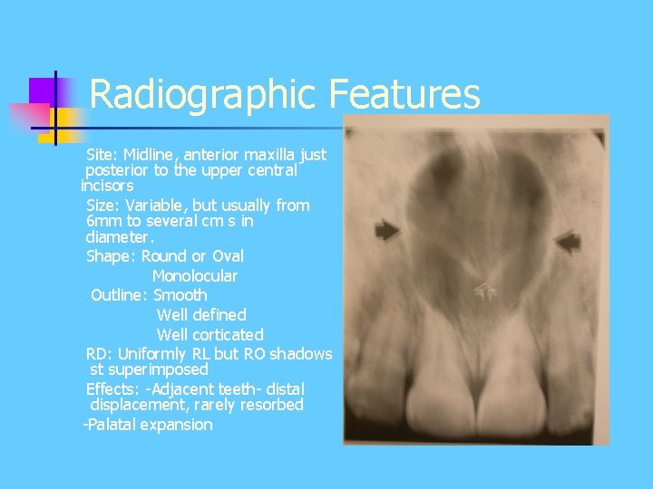 Radiographic Features Site: Midline, anterior maxilla just posterior to the upper central incisors Size: Radiographic Features Site: Midline, anterior maxilla just posterior to the upper central incisors Size: