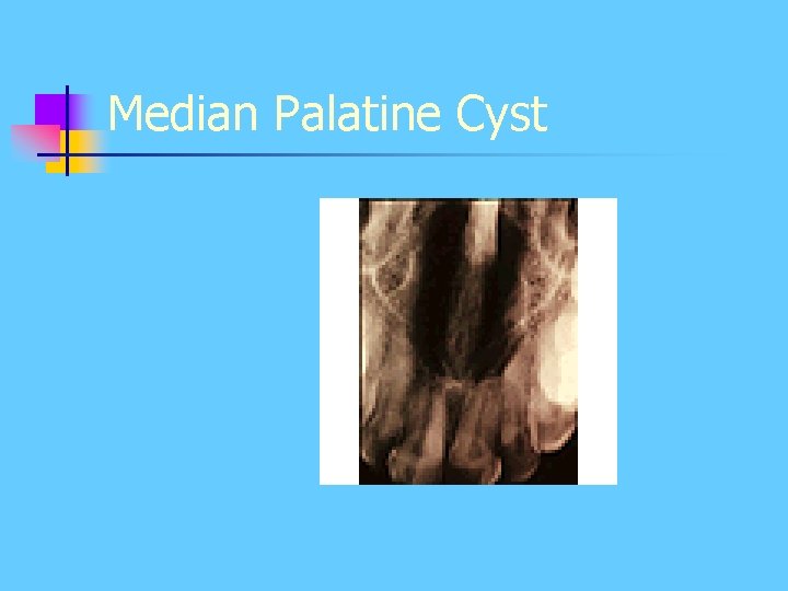 Median Palatine Cyst Median Palatine Cyst