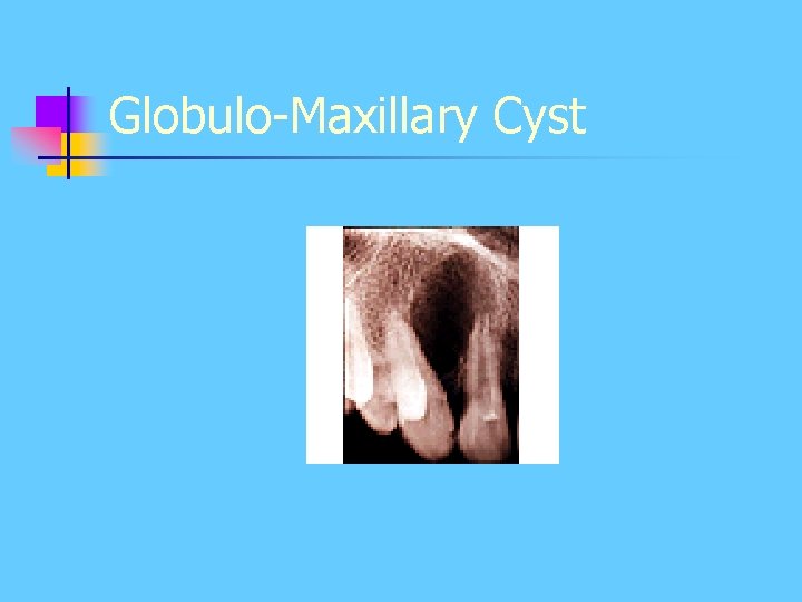 Globulo-Maxillary Cyst Globulo-Maxillary Cyst