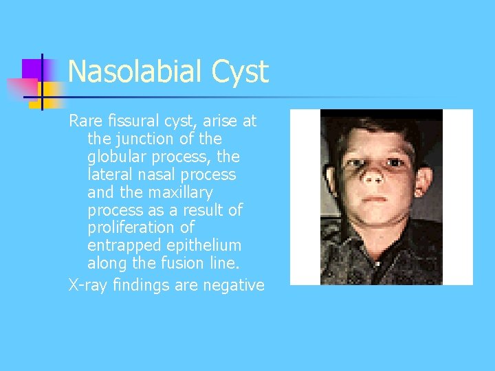 Nasolabial Cyst Rare fissural cyst, arise at the junction of the globular process, the Nasolabial Cyst Rare fissural cyst, arise at the junction of the globular process, the
