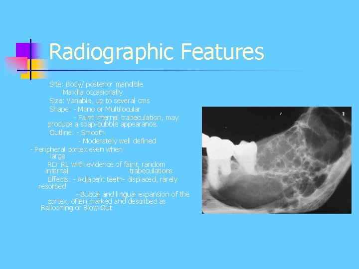 Radiographic Features Site: Body/ posterior mandible Maxilla occasionally Size: Variable, up to several cms Radiographic Features Site: Body/ posterior mandible Maxilla occasionally Size: Variable, up to several cms