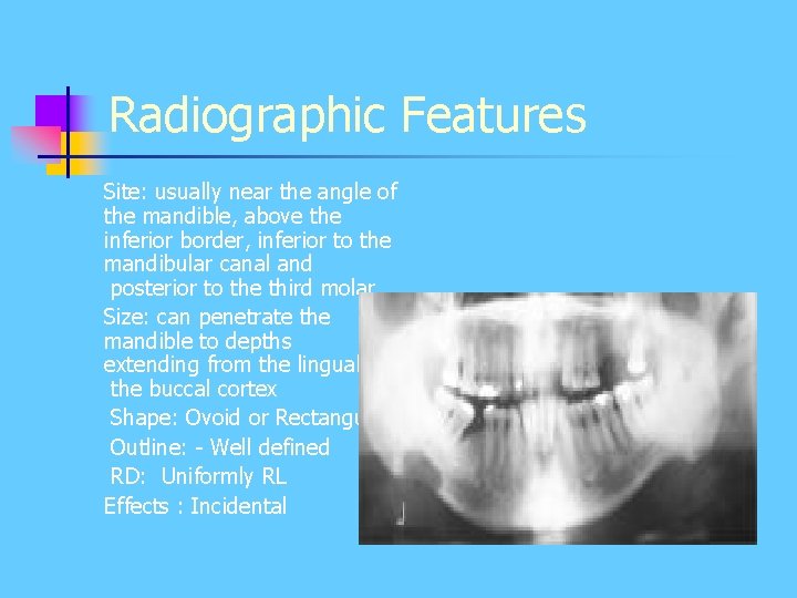 Radiographic Features Site: usually near the angle of the mandible, above the inferior border, Radiographic Features Site: usually near the angle of the mandible, above the inferior border,
