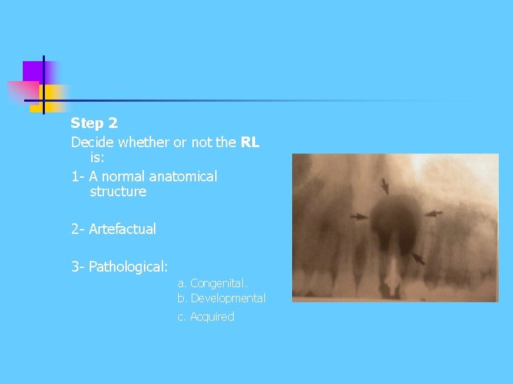 Step 2 Decide whether or not the RL is: 1 - A normal anatomical Step 2 Decide whether or not the RL is: 1 - A normal anatomical