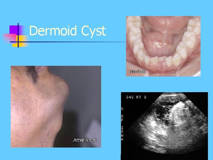 Dermoid Cyst Dermoid Cyst