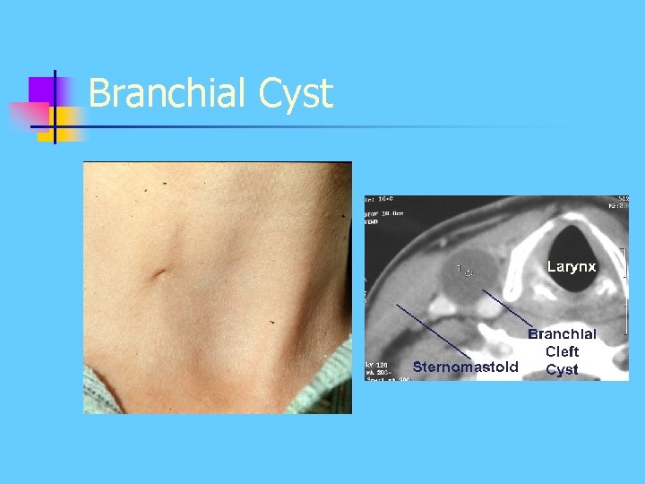 Branchial Cyst Branchial Cyst