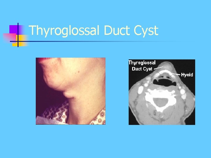 Thyroglossal Duct Cyst Thyroglossal Duct Cyst