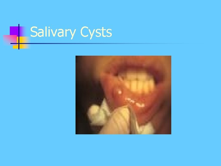 Salivary Cysts Salivary Cysts
