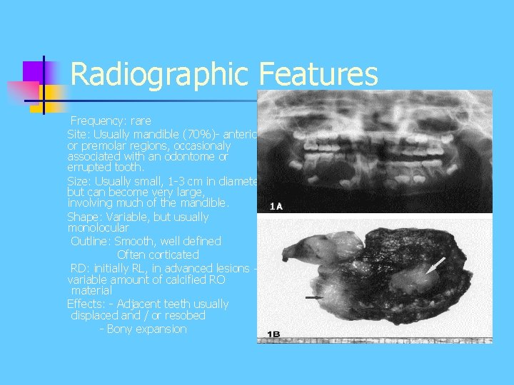 Radiographic Features Frequency: rare Site: Usually mandible (70%)- anterior or premolar regions, occasionaly associated Radiographic Features Frequency: rare Site: Usually mandible (70%)- anterior or premolar regions, occasionaly associated