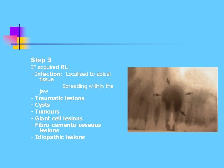 Step 3 IF acquired RL: - Infection; Localized to apical tissue Spreading within the Step 3 IF acquired RL: - Infection; Localized to apical tissue Spreading within the