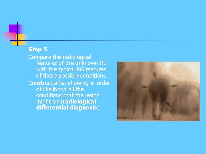 Step 5 Compare the radiological features of the unknown RL with the typical RG Step 5 Compare the radiological features of the unknown RL with the typical RG