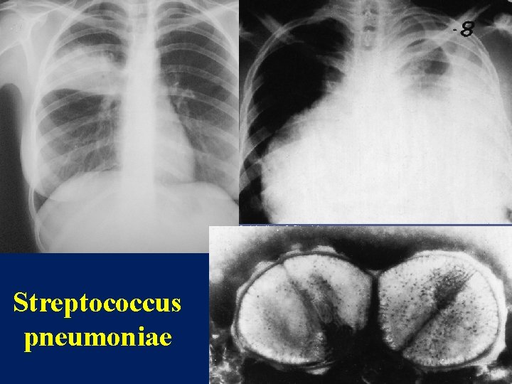Streptococcus pneumoniae 
