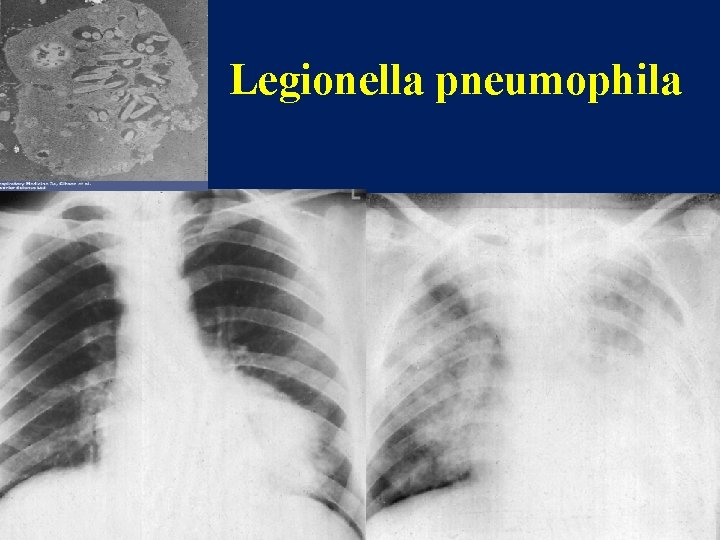 Legionella pneumophila 