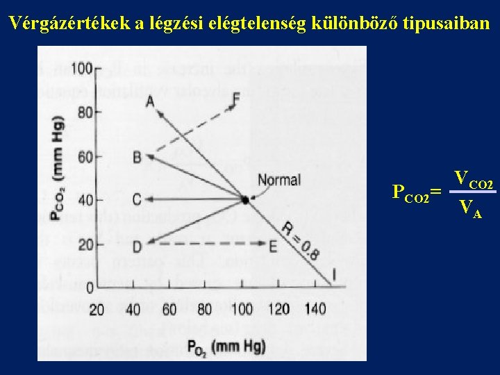 Vérgázértékek a légzési elégtelenség különböző tipusaiban VCO 2 PCO 2= VA 