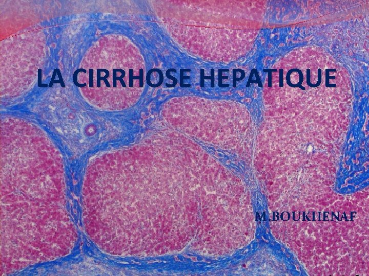 LA CIRRHOSE HEPATIQUE M. BOUKHENAF 