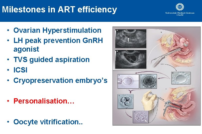 Milestones in ART efficiency • Ovarian Hyperstimulation • LH peak prevention Gn. RH agonist Milestones in ART efficiency • Ovarian Hyperstimulation • LH peak prevention Gn. RH agonist