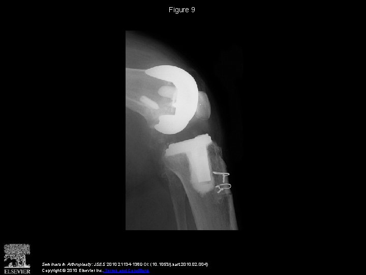 Figure 9 Seminars in Arthroplasty: JSES 2010 21134 -138 DOI: (10. 1053/j. sart. 2010.