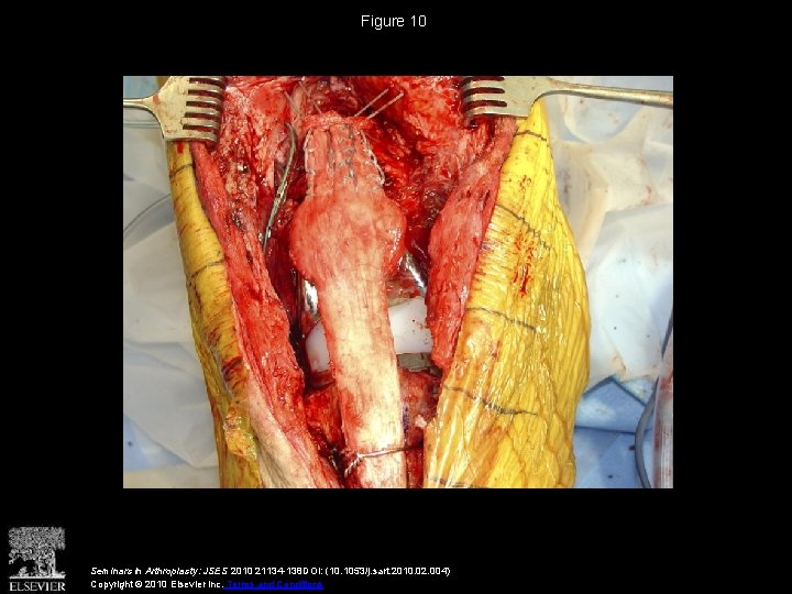Figure 10 Seminars in Arthroplasty: JSES 2010 21134 -138 DOI: (10. 1053/j. sart. 2010.