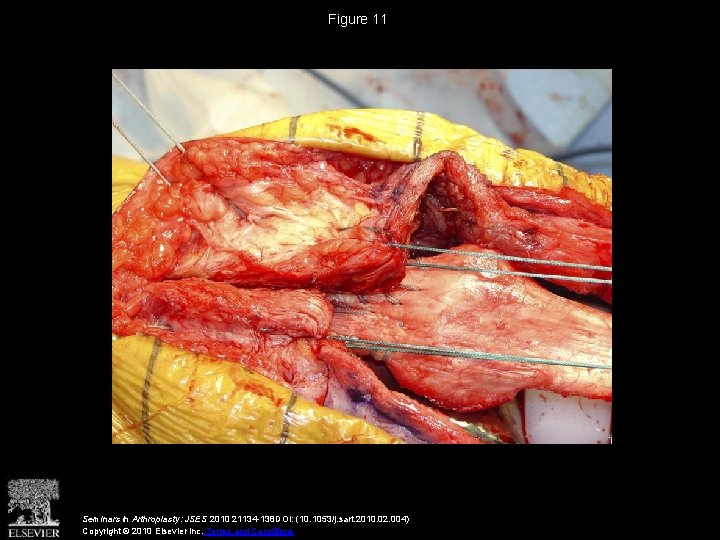 Figure 11 Seminars in Arthroplasty: JSES 2010 21134 -138 DOI: (10. 1053/j. sart. 2010.