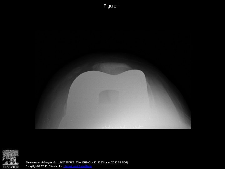 Figure 1 Seminars in Arthroplasty: JSES 2010 21134 -138 DOI: (10. 1053/j. sart. 2010.