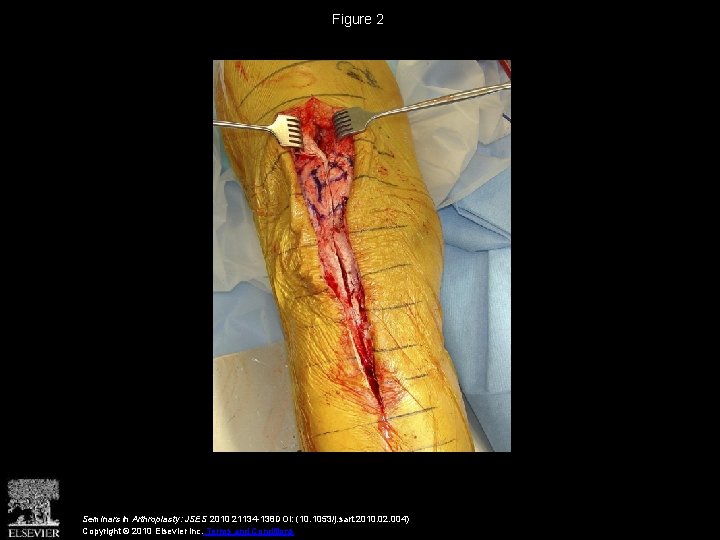 Figure 2 Seminars in Arthroplasty: JSES 2010 21134 -138 DOI: (10. 1053/j. sart. 2010.
