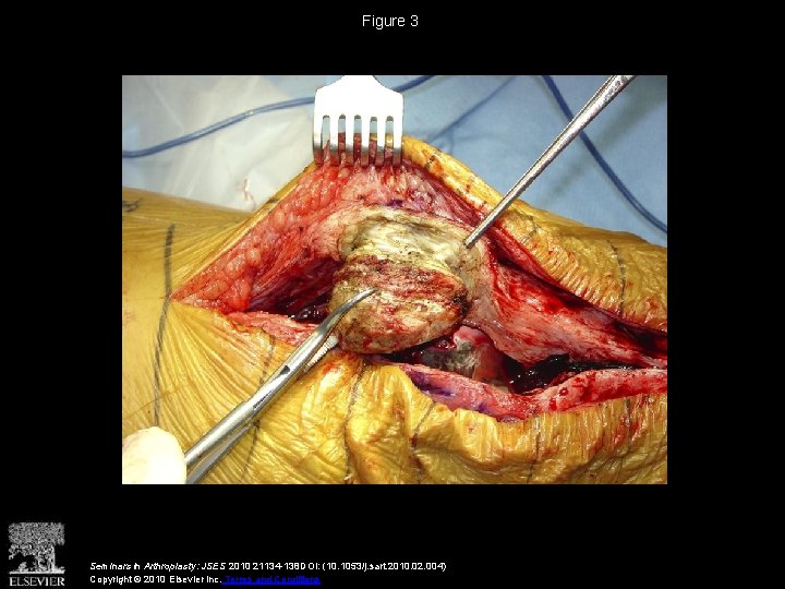 Figure 3 Seminars in Arthroplasty: JSES 2010 21134 -138 DOI: (10. 1053/j. sart. 2010.