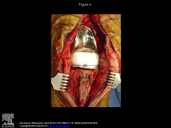 Figure 4 Seminars in Arthroplasty: JSES 2010 21134 -138 DOI: (10. 1053/j. sart. 2010.