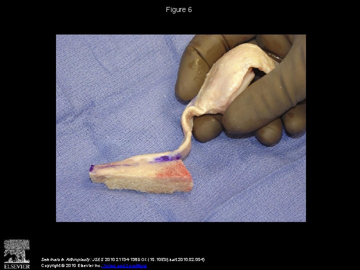 Figure 6 Seminars in Arthroplasty: JSES 2010 21134 -138 DOI: (10. 1053/j. sart. 2010.