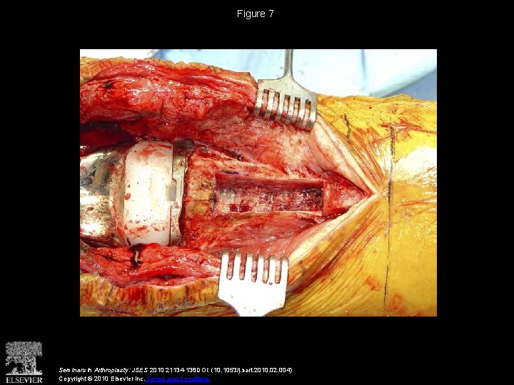 Figure 7 Seminars in Arthroplasty: JSES 2010 21134 -138 DOI: (10. 1053/j. sart. 2010.