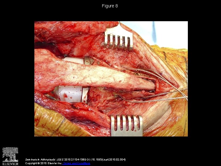 Figure 8 Seminars in Arthroplasty: JSES 2010 21134 -138 DOI: (10. 1053/j. sart. 2010.