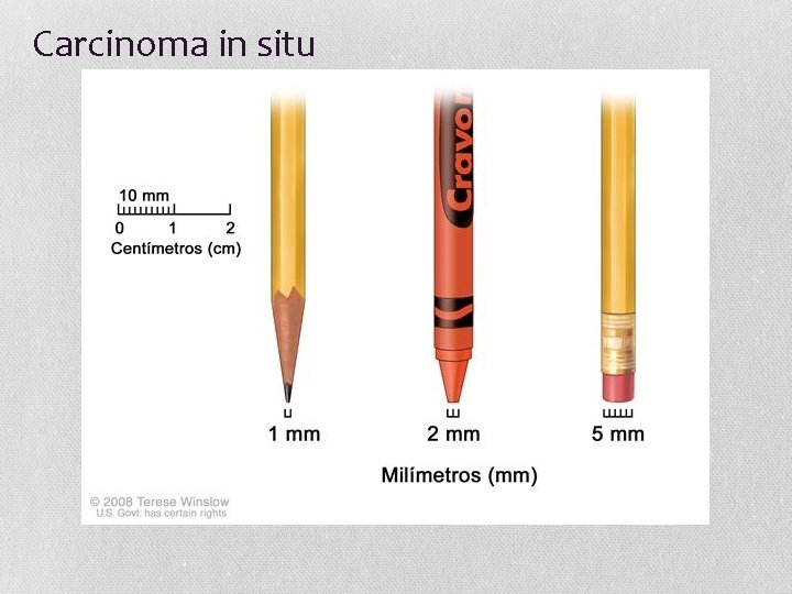 Carcinoma in situ 