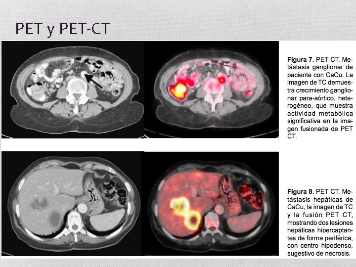 PET y PET-CT 