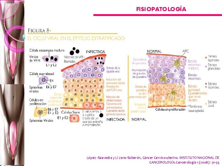 FISIOPATOLOGÍA López -Saavedra y Li zano-Soberón, Cáncer Cervico-uterino. INSTITUTO NACIONAL DE CANCEROLOGÍA. Cancerología 1