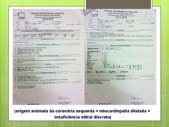 (origem anômala da coronária esquerda + miocardiopatia dilatada + insuficiência mitral discreta) 