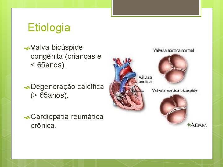 Etiologia Valva bicúspide congênita (crianças e < 65 anos). Degeneração calcífica (> 65 anos).