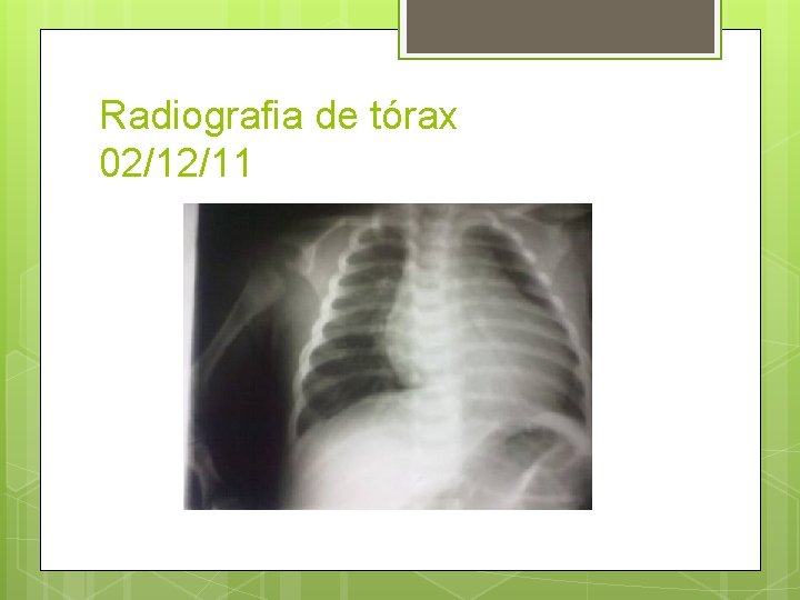 Radiografia de tórax 02/12/11 