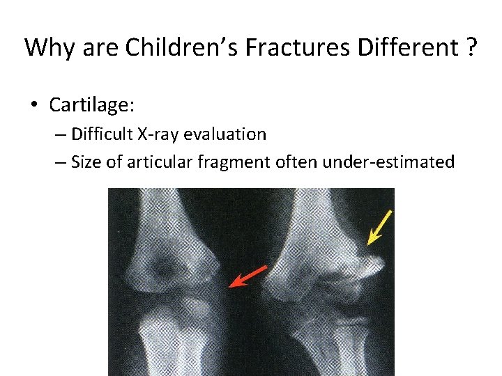 Why are Children’s Fractures Different ? • Cartilage: – Difficult X-ray evaluation – Size