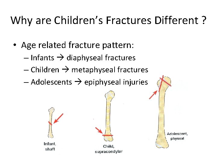 Why are Children’s Fractures Different ? • Age related fracture pattern: – Infants diaphyseal