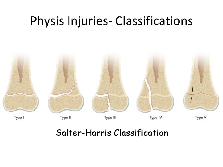 Physis Injuries- Classifications Salter-Harris Classification 