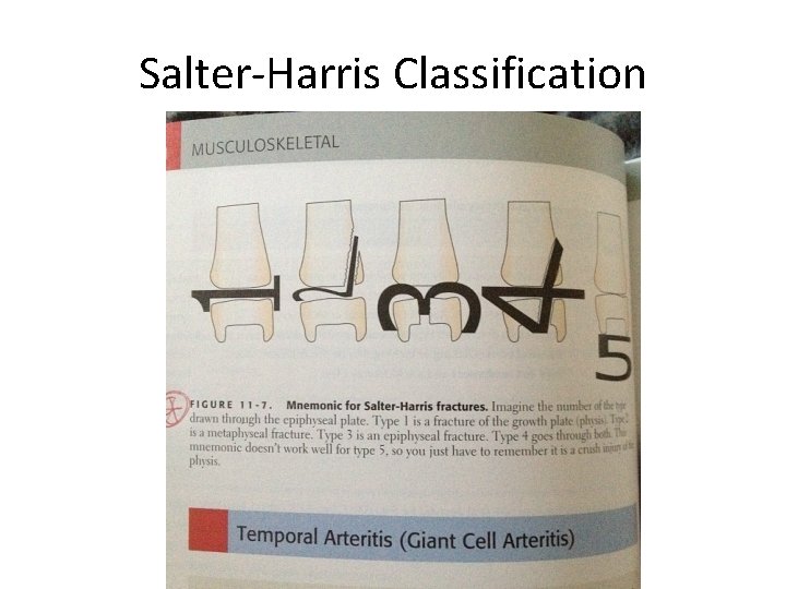 Salter-Harris Classification 
