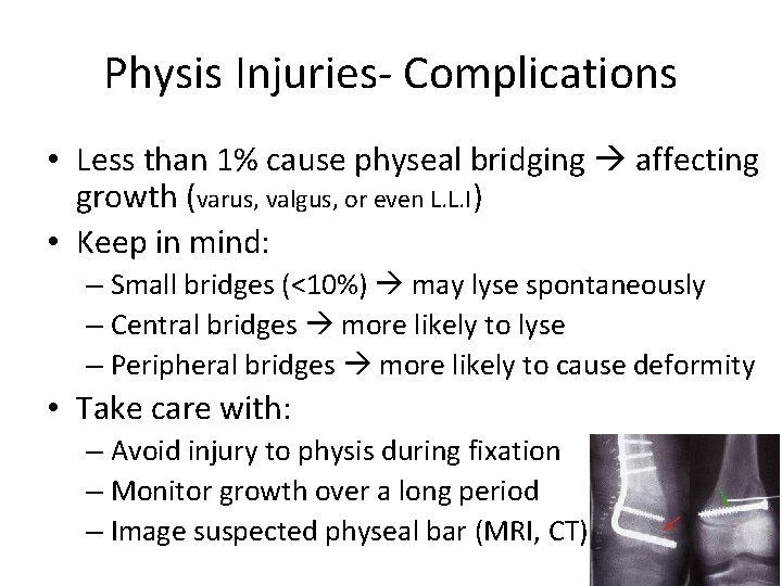 Physis Injuries- Complications • Less than 1% cause physeal bridging affecting growth (varus, valgus,