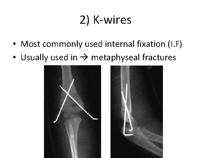 2) K-wires • Most commonly used internal fixation (I. F) • Usually used in