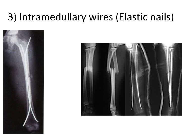 3) Intramedullary wires (Elastic nails) 