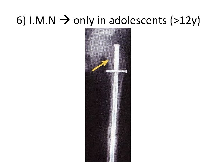 6) I. M. N only in adolescents (>12 y) 