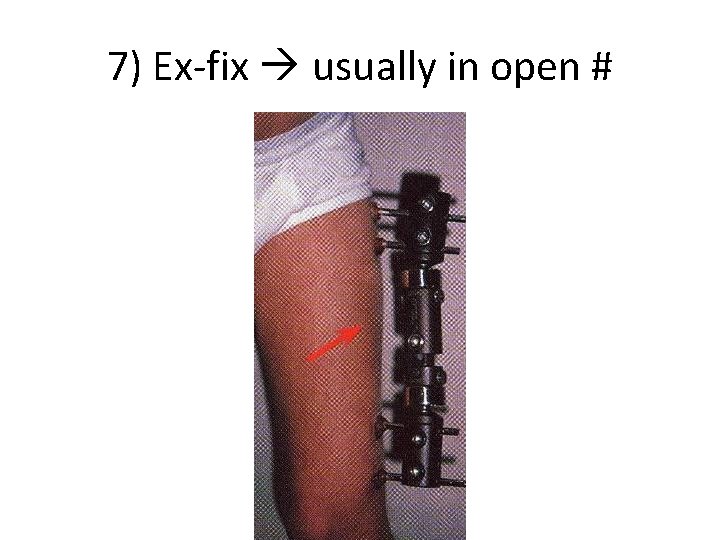 7) Ex-fix usually in open # 