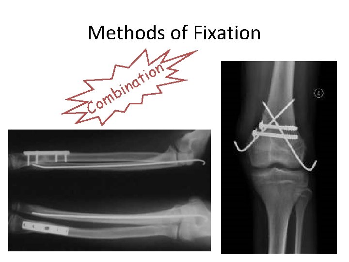 Methods of Fixation Co a n i mb n o i t 