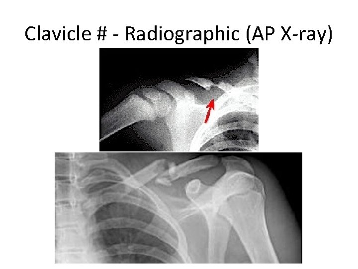 Clavicle # - Radiographic (AP X-ray) 