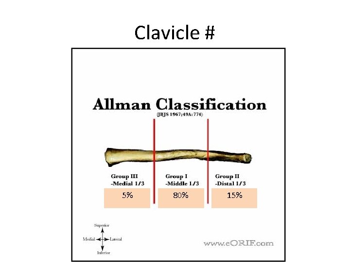 Clavicle # 5% 80% 15% 